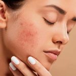 Non-Invasive Treatment for Acne
